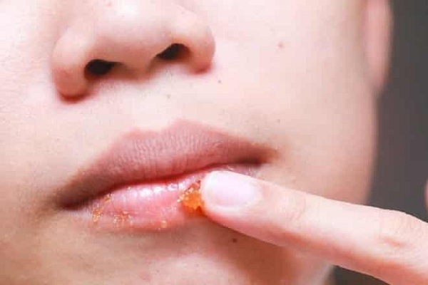 Tẩy da chết cho môi bằng đường trắng, chanh và mật ong 1