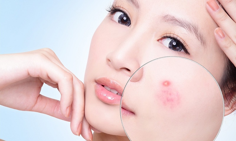 Cách làm sạch da mặt bị mụn giúp giảm thâm, mau lành hiệu quả 1