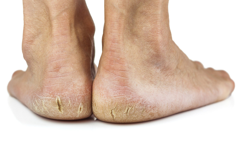 Nứt gót chân, nguyên nhân và cách điều trị