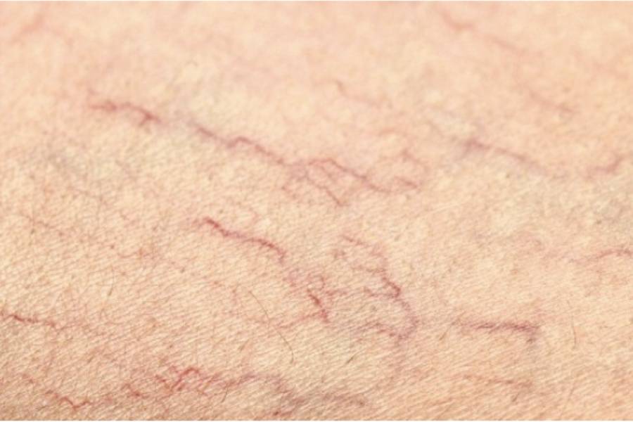 Hướng dẫn cách chăm sóc da mặt mỏng nổi mạch máu