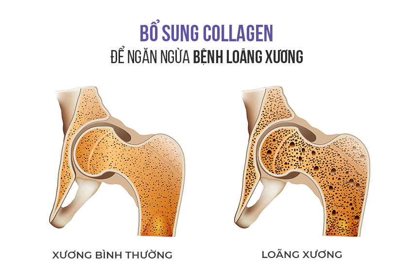 Bổ sung collagen giúp xương chắc khỏe và phòng ngừa bệnh loãng xương