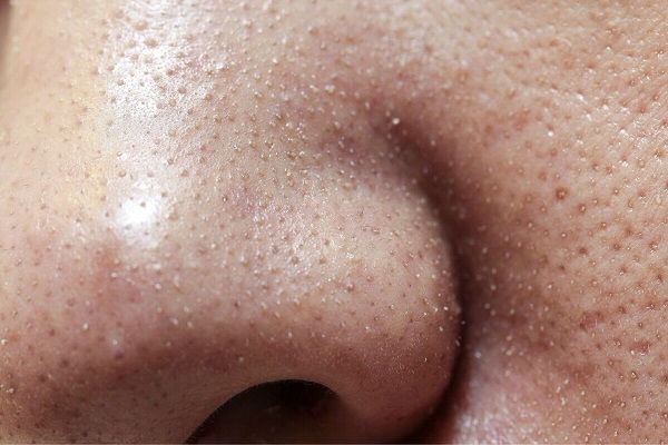 6 nguyên nhân khiến da mặt sần sùi nhiều mụn cám và cách điều trị dứt điểm.jpg